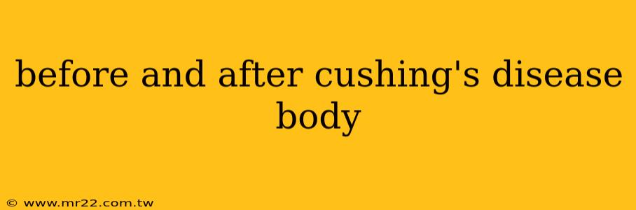 before and after cushing's disease body
