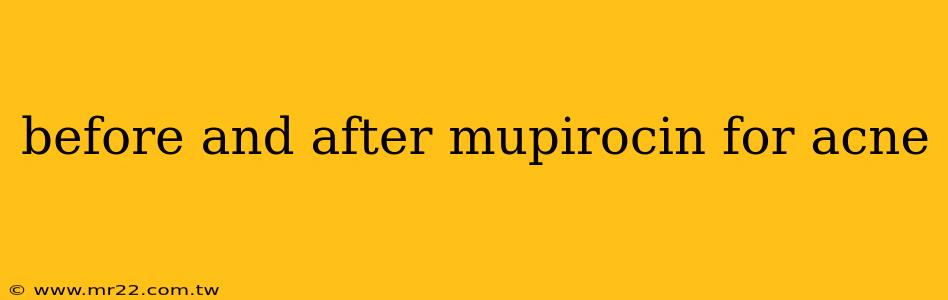 before and after mupirocin for acne