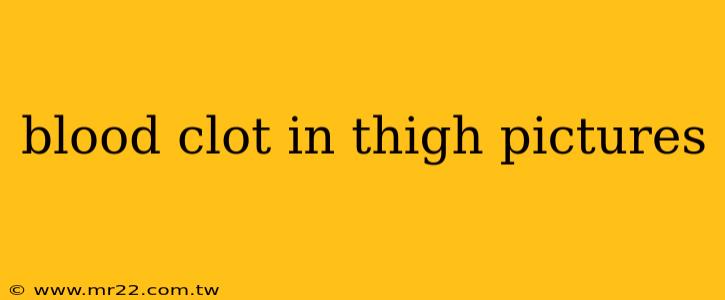 blood clot in thigh pictures