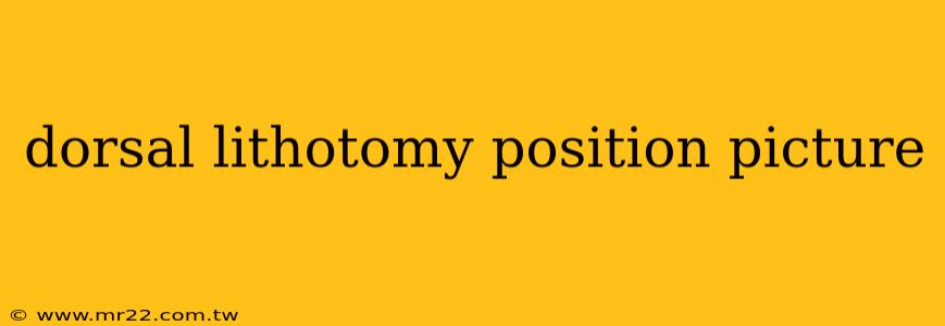 dorsal lithotomy position picture