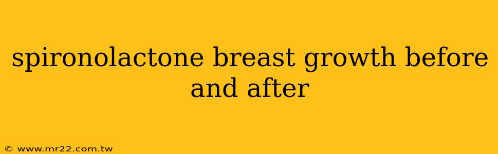 spironolactone breast growth before and after